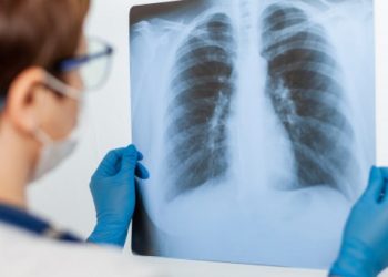 Kemenkes Perluas Layanan Mobile X-ray Untuk Skrining TBC di 7 Provinsi