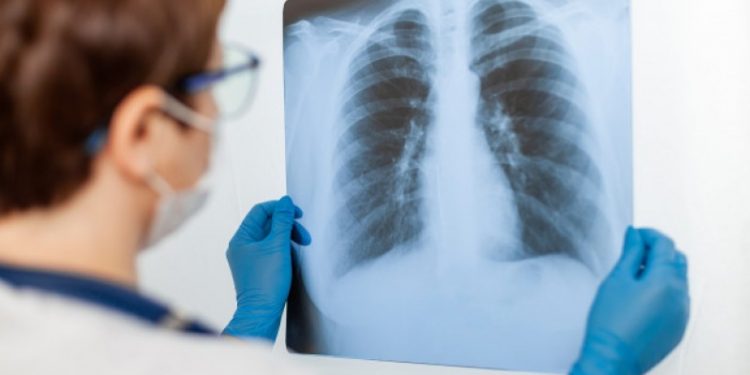 Kemenkes Perluas Layanan Mobile X-ray Untuk Skrining TBC di 7 Provinsi