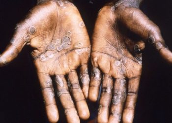 DPR Minta Kemenkes Berkomunikasi Dengan WHO Soal Cacar Monyet