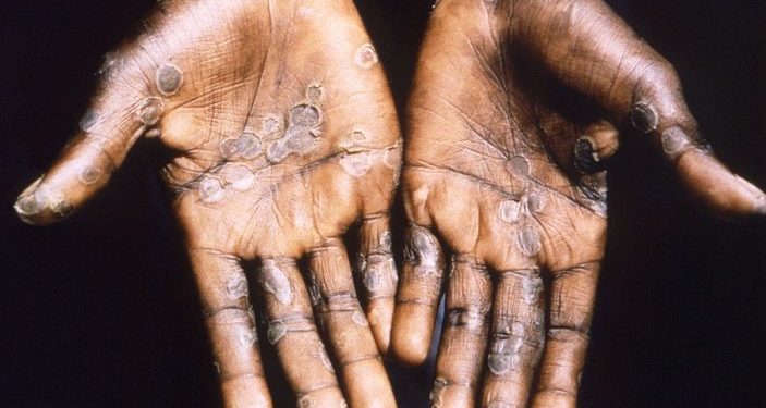 DPR Minta Kemenkes Berkomunikasi Dengan WHO Soal Cacar Monyet