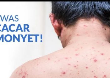 Kasus Cacar Monyet Pertama Terdeteksi, Kemenkes Siapkan 10.000 Vaksin