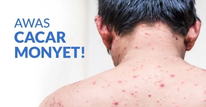 Kasus Cacar Monyet Pertama Terdeteksi, Kemenkes Siapkan 10.000 Vaksin