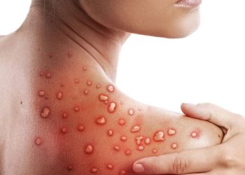 Gambar ilustrasi cacar monyet