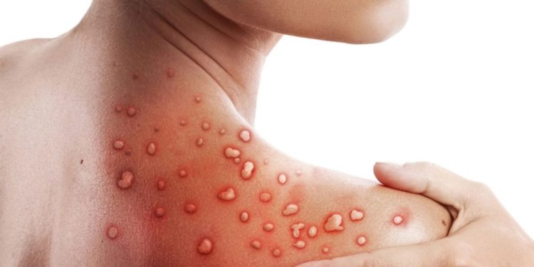 Gambar ilustrasi cacar monyet