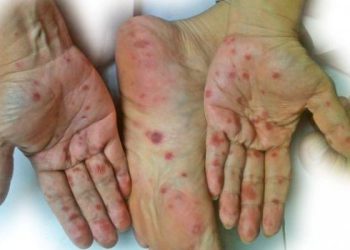 Jangan Anggap Enteng! Kenali Gejala Flu Singapura dan Cara Ampuh Mencegahnya!